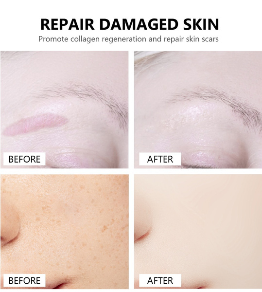 QLZHANFU Crocodile Scar Repair Serum Acne Treatment Bristningar Borttagning Akne Ärrblekning för fläckar Hudvård 30ml_voghion.com