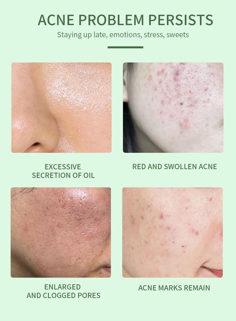 Anti-Akne-Serum, Essenz zur Behandlung von Akne, Pickeln und verstopften Poren – 30 ml_voghion.com