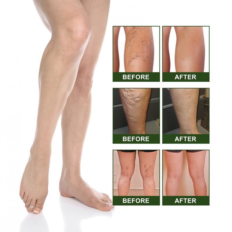 Das Moon South Venous Care Fußpflaster lindert venöse Übersäuerung, macht schlank, schwillt an und pflegt das Fußpflaster_voghion.com