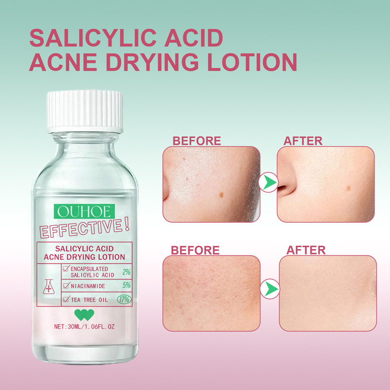 Salicylic Acid Acne Removal Serum Pimples Treatment Anti Whiteheads Oil Control Shrinking Pores Moisturizing Cleansing Skin Care Face care_voghion.com