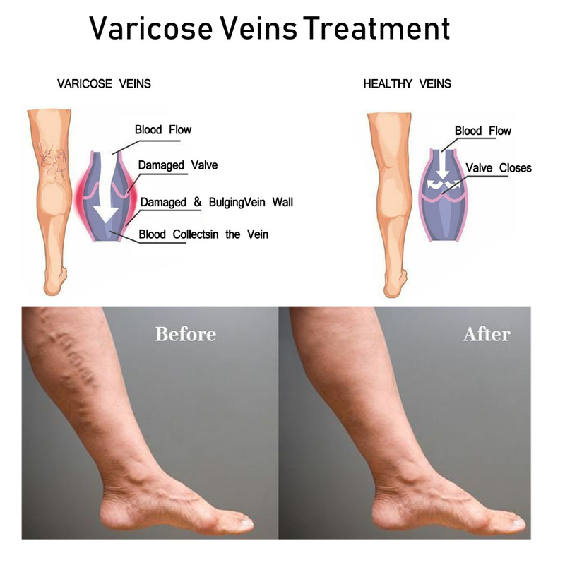 Bacaktaki Ağrı ve Vasküler Şişkinlik İçin Rahatlatıcı Venöz Ven Masajı Varis Giderici Krem_voghion.com