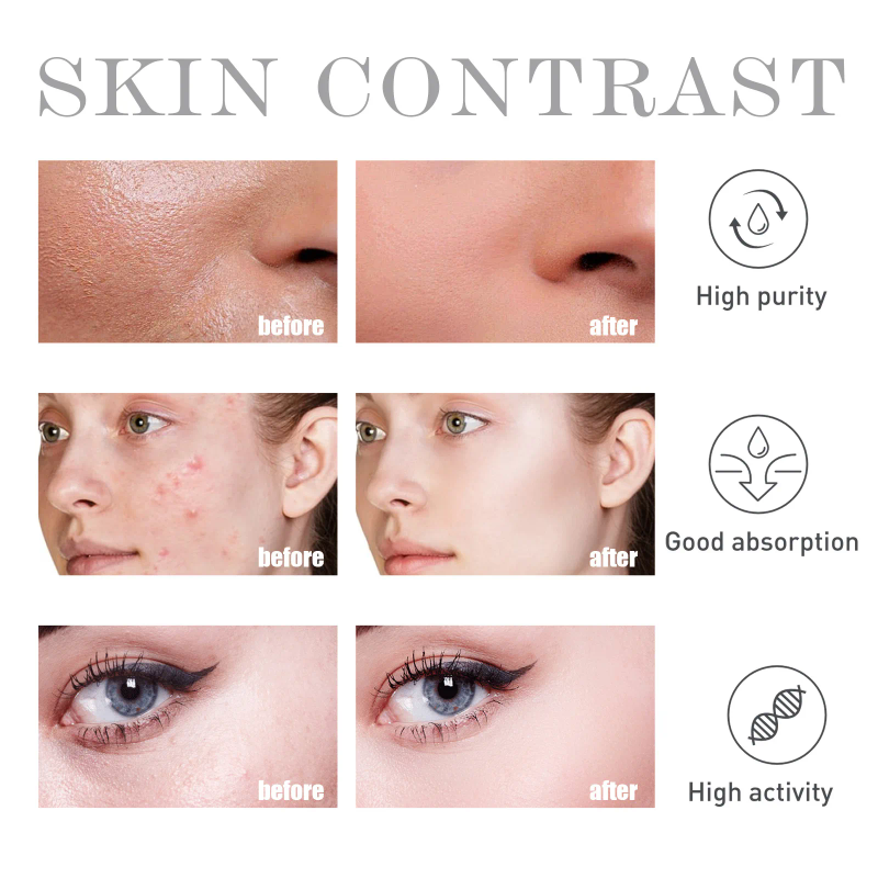 Akne-Behandlungsserum. Gewöhnliche Salicylsäure-Seren entfernen Pickel, Mitesser, Anti-Akne-Poren, schrumpfen die Hautverjüngungsessenz_voghion.com