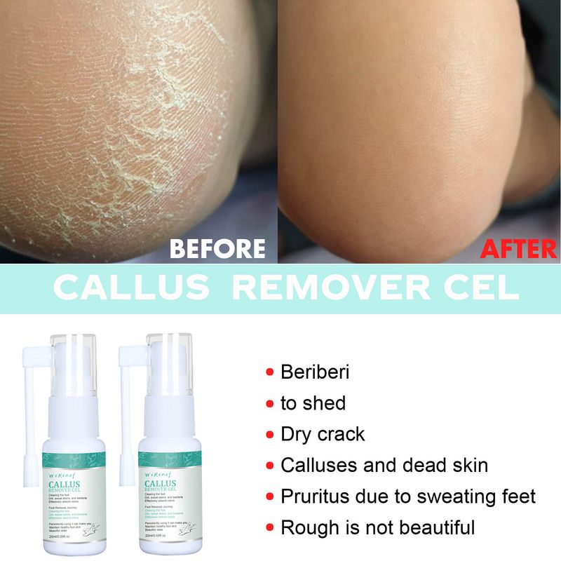 Spray Esfoliante Corpo, Mãos e Pés, Alivia a Pele Morta, Esfolia Hidrata e Limpa Profundamente_voghion.com