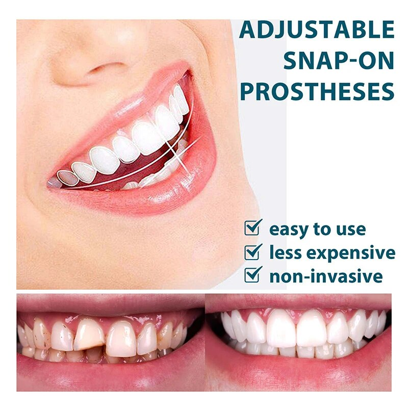 Set regolabile Impiallacciatura sorridente istantanea Sbiancamento denti per protesi Decora gli spazi tra i denti_voghion.com