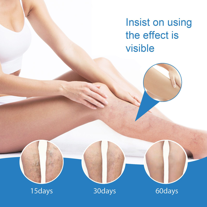 Soothing Venous 2024 Vein Massage Varicose Relief Cream for Pain and Vascular Bulging in the Leg_voghion.com