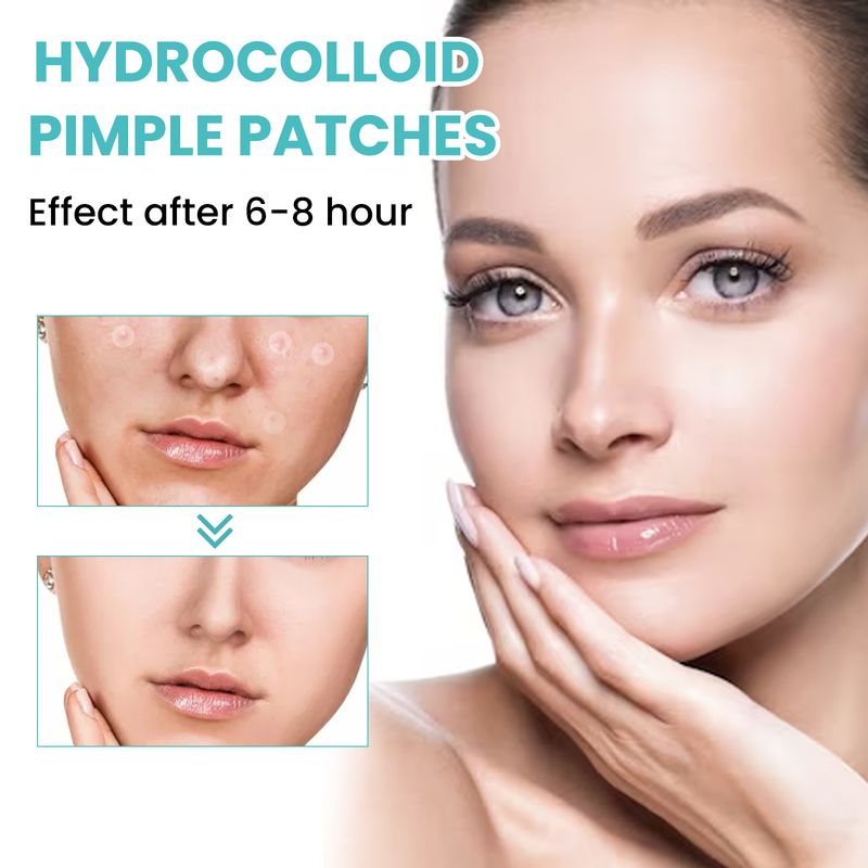 West&Month Acne Patch (300pcs) Repairs Acne And Blackheads, Cleans Pores, Is Invisible, Breathable, Concealer And Waterproof_voghion.com