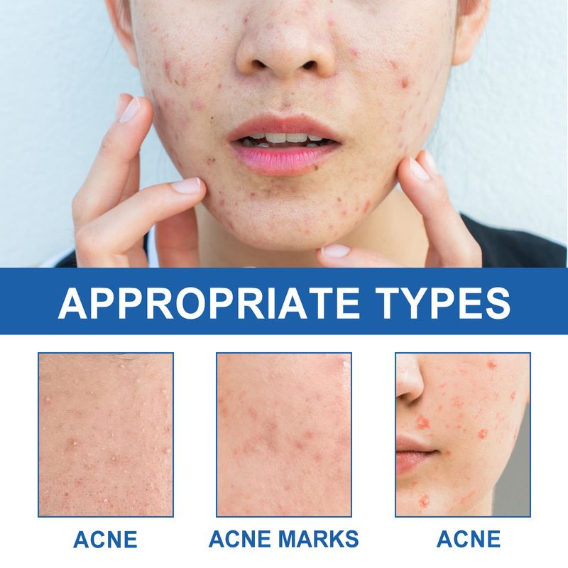 OUHOE Facial Care Patch Breathable To Reduce Face Closed Acne Skin Tone Modification_voghion.com