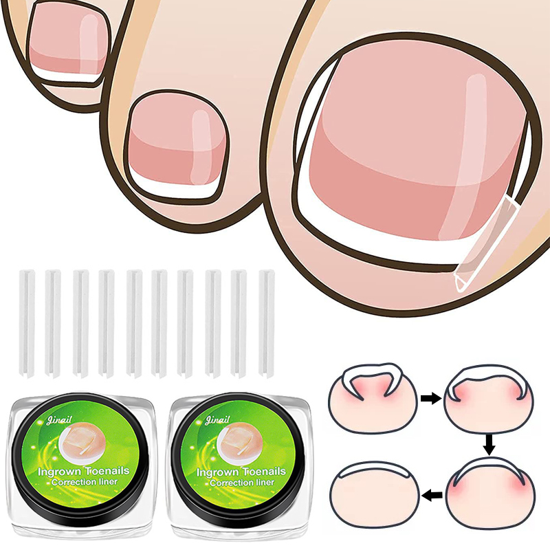 10 stks Ingegroeide Teennagels Pedicure Voet Nagelverzorging Gereedschap Medische C-vormige Buis Embedden Paronychia Pedicure Behandeling_voghion.com