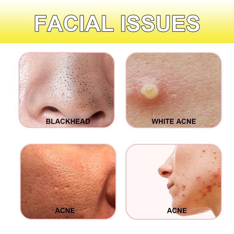 Jaysuing Acne Hydrocolloid Patch For Cleansing Facial Acne, Closing Mouth And Removing Blackheads Delicate Skin Patch_voghion.com