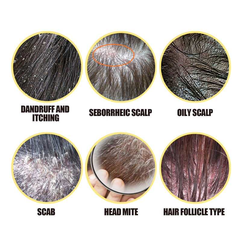 Sulfur Shampoo 50g Remove Lice Mites Dandruff Itching Oil Cleaning Scalp Deep Hair Antipruritic Follicles Cleaning_voghion.com