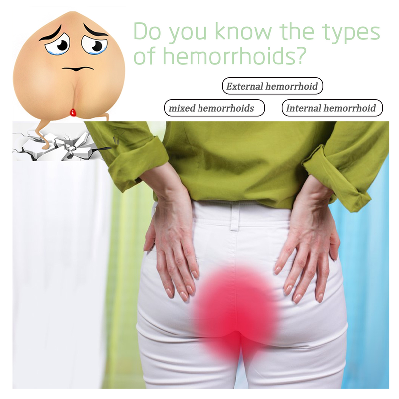 Cremă pentru hemoroizi Relief Beautiful pentru repararea analului, îndepărtarea lânii, ameliorarea umflăturilor, hemoroizi, dureri, ,_voghion.com