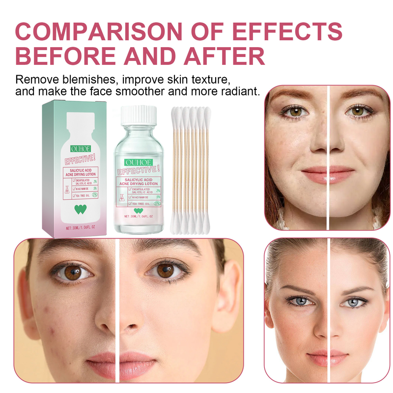 Salicylic Acid Acne Removal Serum Pimples Treatment Anti Whiteheads Oil Control Shrinking Pores Moisturizing Cleansing Skin Care Face care_voghion.com