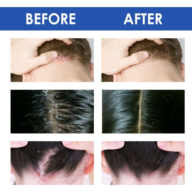 Cremă seboreică South Moon pentru repararea problemelor pielii precum acneea, mâncărimea și psoriazisul de pe cap_voghion.com
