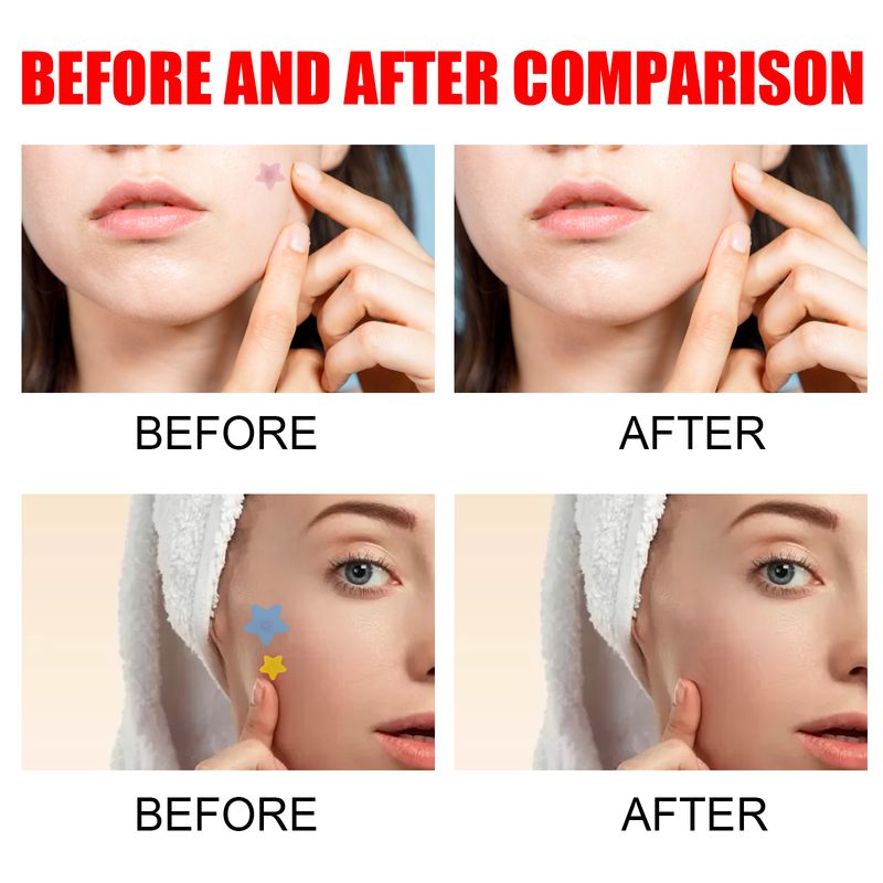 Jaysuing Pimples Patch, Repair Pockmarks Lighten Pimples Blemishes Cover Pimples_voghion.com