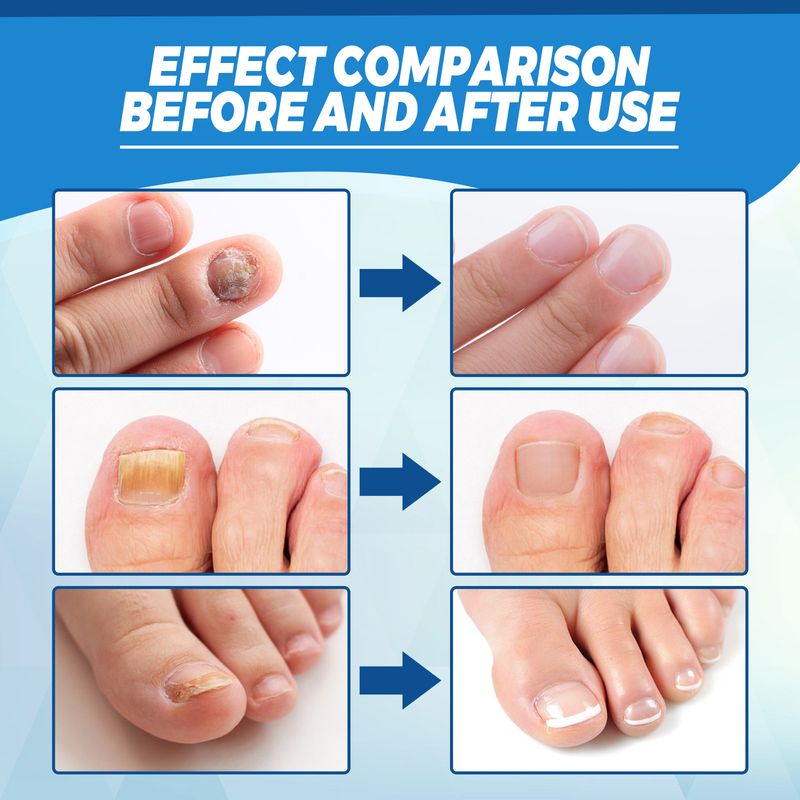 Blue Light Onychomycosis Laser Pen Simple And Easy To Use Odor Removal Nail Care_voghion.com