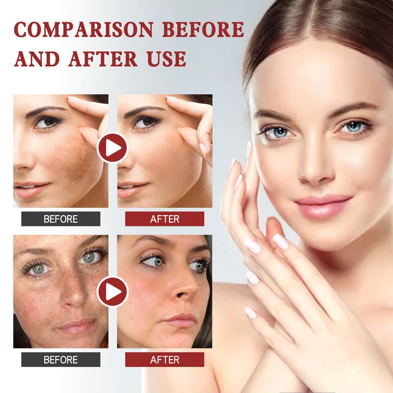 Crema blanqueadora de manchas EELHOE para reparar cicatrices de acné, reducir la opacidad, atenuar manchas, hidratar, nutrir y reafirmar._voghion.com