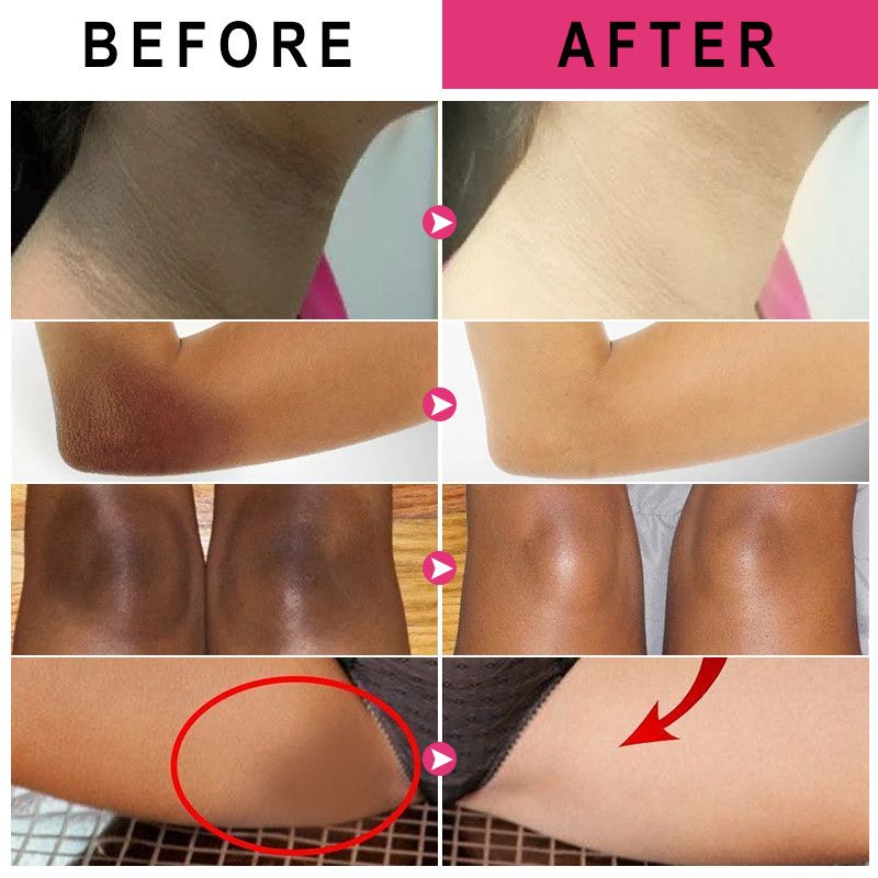 C-vitaminos fehérítő hónalj, könyök, térd hidratáló testápoló, ragyogást fokozó krém, melanin 2024 népszerű_voghion.com