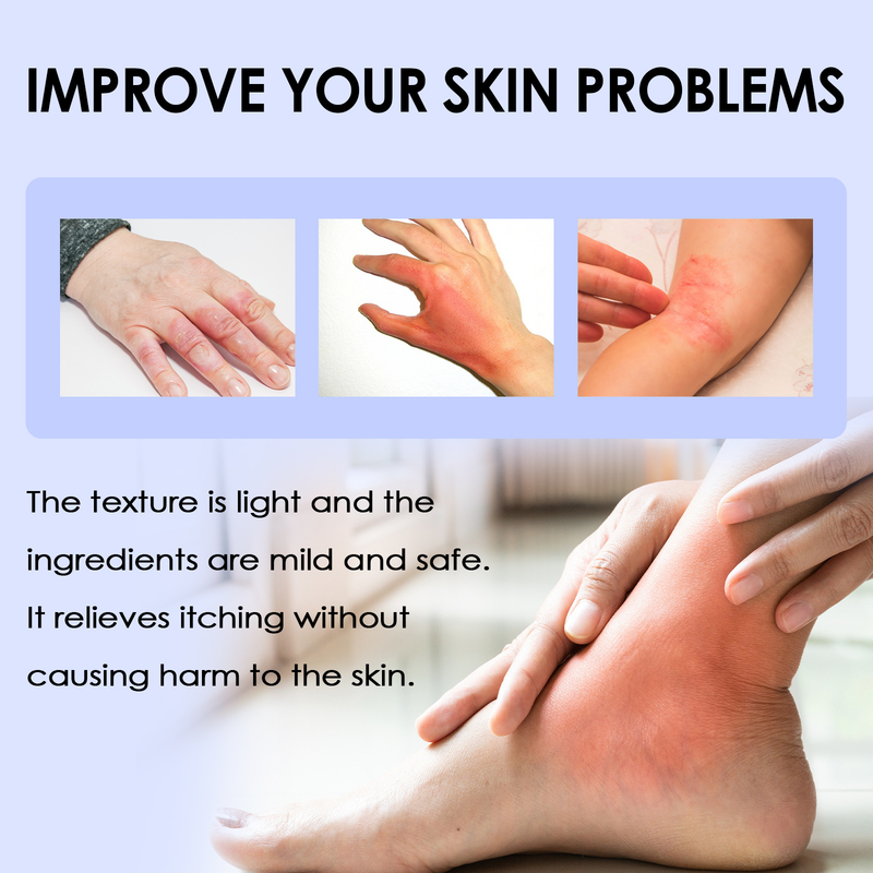 South Moon Zihua Di Ding Skin Antipruritus Tørr hud, kløe, rødhetslindrende fuktighetsgivende pleiekrem_voghion.com