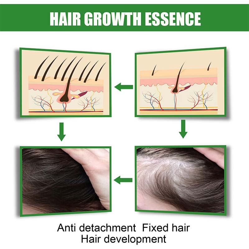 Ingwer-Haarwuchsspray-Produkte, natürliches Anti-Haarausfall-Serum, verhindern Haarausfall, Behandlung, schnelles Wachstum, nähren geschädigtes Haar_voghion.com