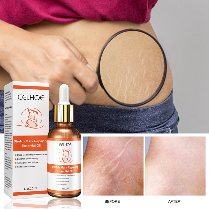 Aceite esencial reparador de cicatrices para mujeres, lifting, relajación, tensado de hilos, aclarado de la piel, líneas de embarazo_voghion.com