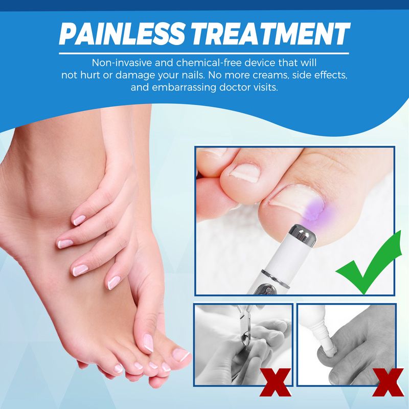 Blue Light Onychomycosis Laser Pen Simple And Easy To Use Odor Removal Nail Care_voghion.com