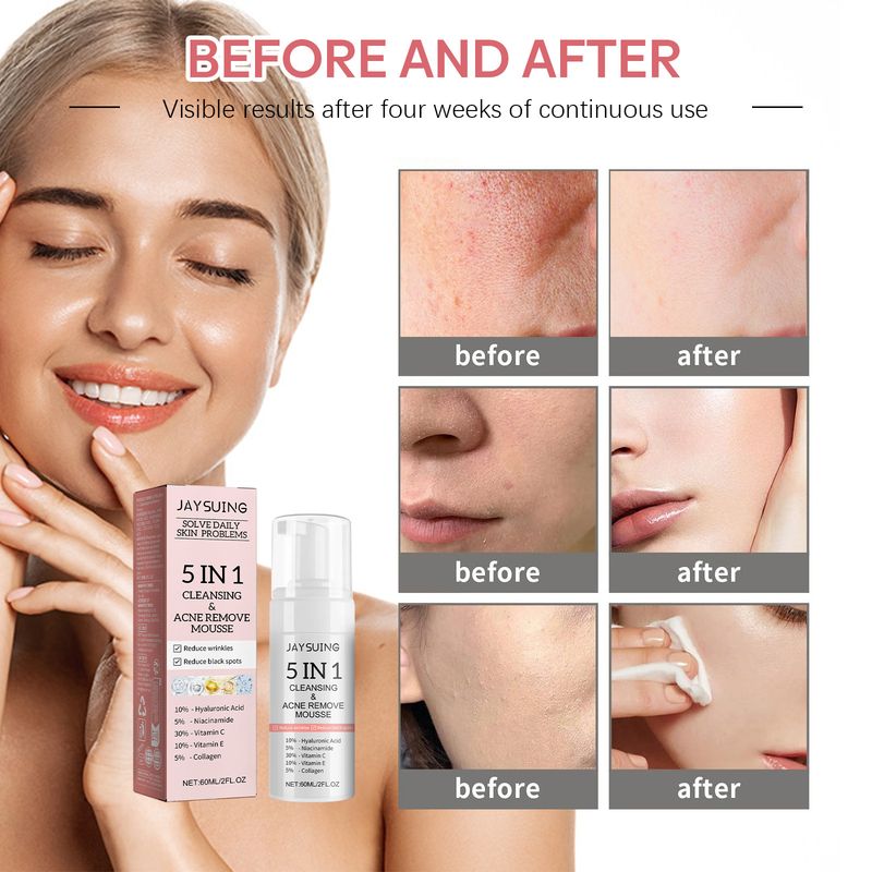Jaysuing 5-en-1 clansing pour clan pors, marques d'acn lightn, rmov blackhads acn, contrôle du pétrole et des clans fac_voghion.com