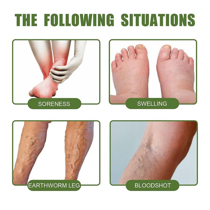 South Moon Varicose Vein Relief Cream 50g_voghion.com