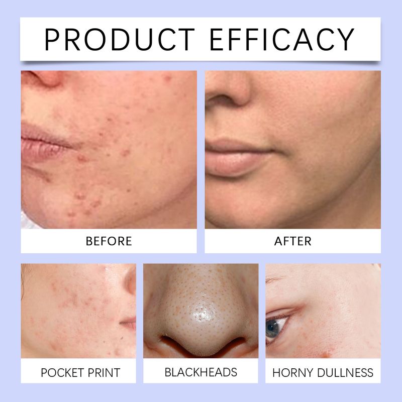 OUHOE Acne Essence Hydrates, Controls Oil, Refines Pores, Lighens Acnes, Improves Red Skin_voghion.com