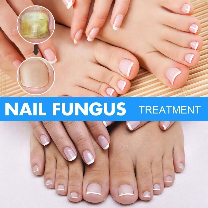 EELHOE 30ml Anti Fungus Liquid Toe Finger Nail Infection Repair Treatment_voghion.com