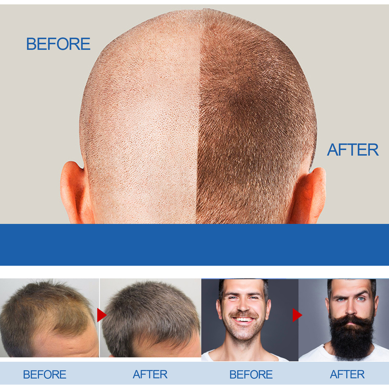 East Moon Loss Prevention Bartpflegekonzentrat für Männer für dickes und festigendes Haar_voghion.com