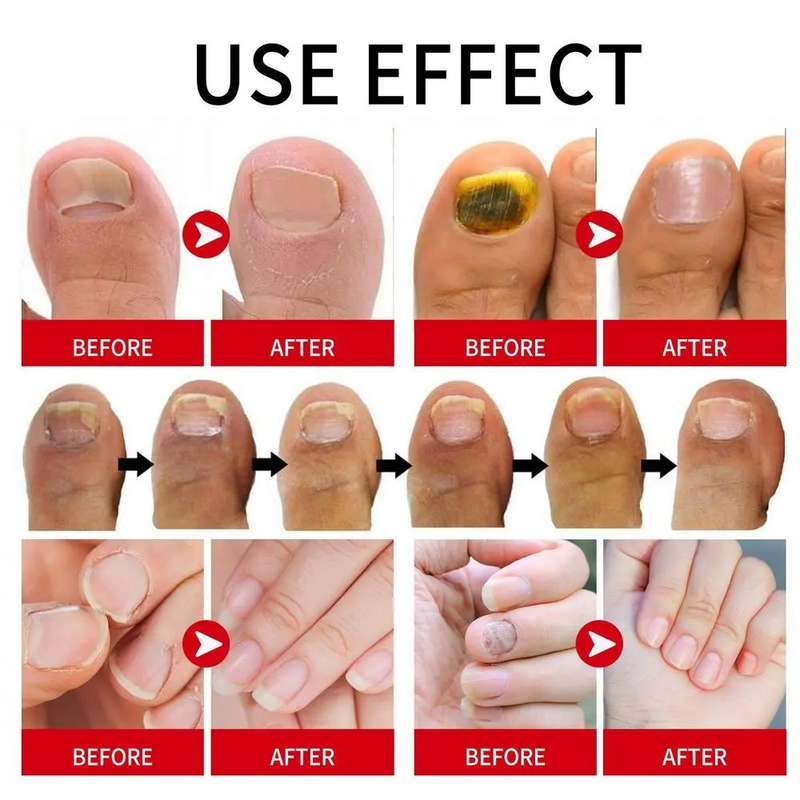 Olio per riparazione unghie Liquido di riparazione per rimozione cuticole per unghie Olio delicato per cuticole per unghie Idratante Indurente per unghie Smalto per la crescita delle unghie_voghion.com