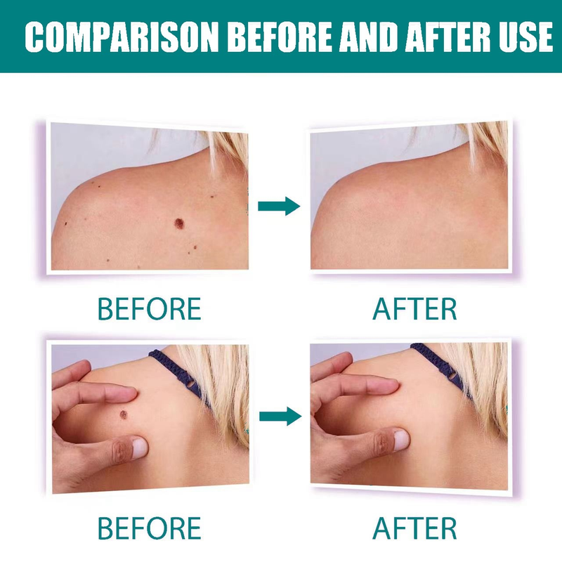 SOL LORA Pen Cream flat specially sharp Ke warts, You Ping Liquid for removing warts_voghion.com