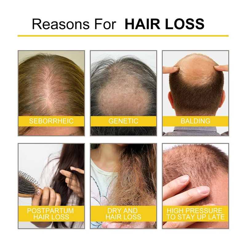 Wachstum 30 ml Ingwer für Männer Frauen Anti-Haarausfall Hydratisiert dichte Reparatur Wurzeln Kopfhautbehandlung Massage Essentials_voghion.com