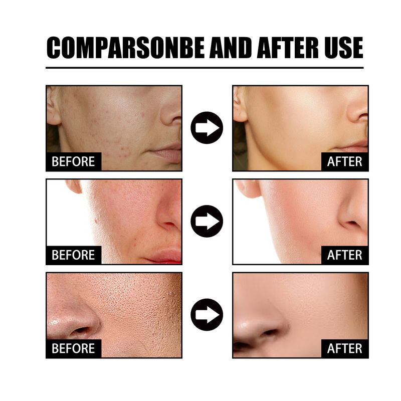 EELHOE Nicotinic Acid Face Essence Lighten Acne Marks, Moisturize Pores, Shrink And Whiten Skin Beauty Essence_voghion.com