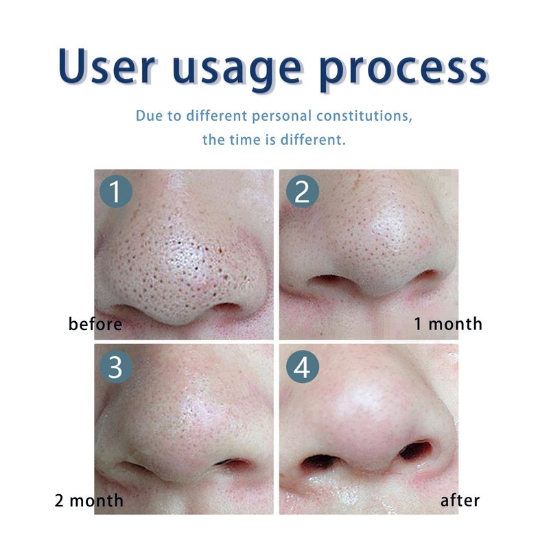 Hoygi Anti-Pimple Drying Lotion, Facial Cleansing And Repair Lighten Acne Marks And Pits, Close Your Mouth And Mild Skin Cream_voghion.com