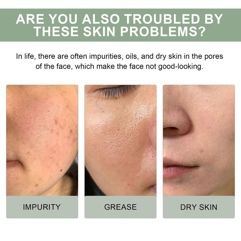 Demachiantul Hoygi Pore Cleansing iluminează pielea feței, curăță în profunzime petele de acnee, curăță, hidratează și hidratează._voghion.com