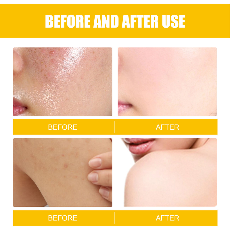 EELHOE Facial Skin Care Cleansing&Reducing Spots, Eliminating Acne and Shrinking Pore essence_voghion.com