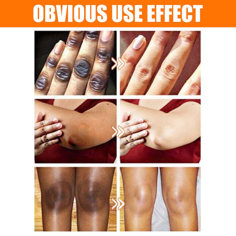 2024 new Acne Whitening Elbow, Axillary, Knee Joint, Black Skin Brightening essence_voghion.com