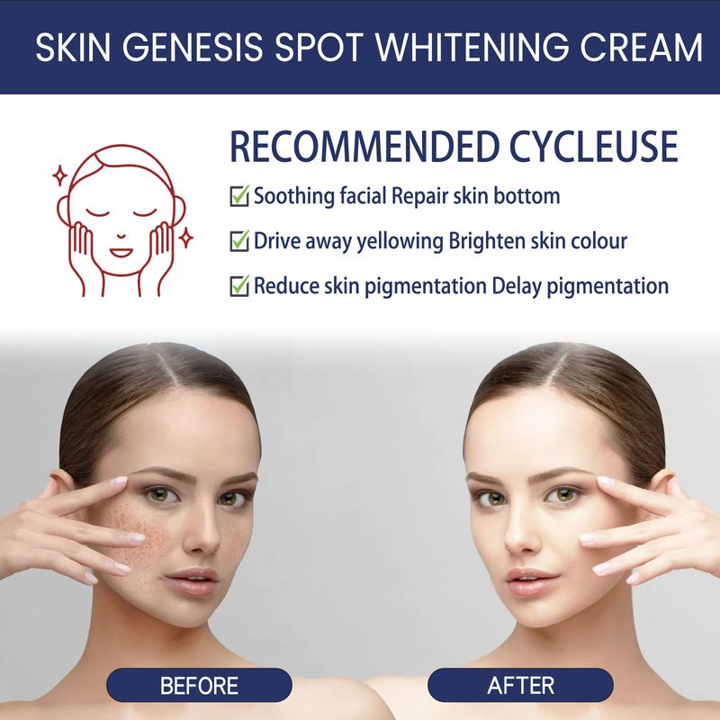 Crema schiarente Hoygi Skin Genesis Spot Whitening Cream, diluire le macchie, pelle liscia e colore bianco brillante. Questa delicata crema idratante per la pelle._voghion.com