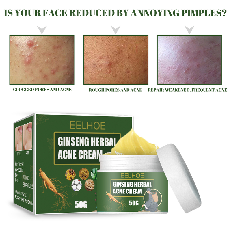 EELHOE augu krēms, noņemot, pret pinnēm, mitrinošs, attīrošs sejas krēms, eļļas un ūdens līdzsvara noņēmējs pret pinnēm_voghion.com