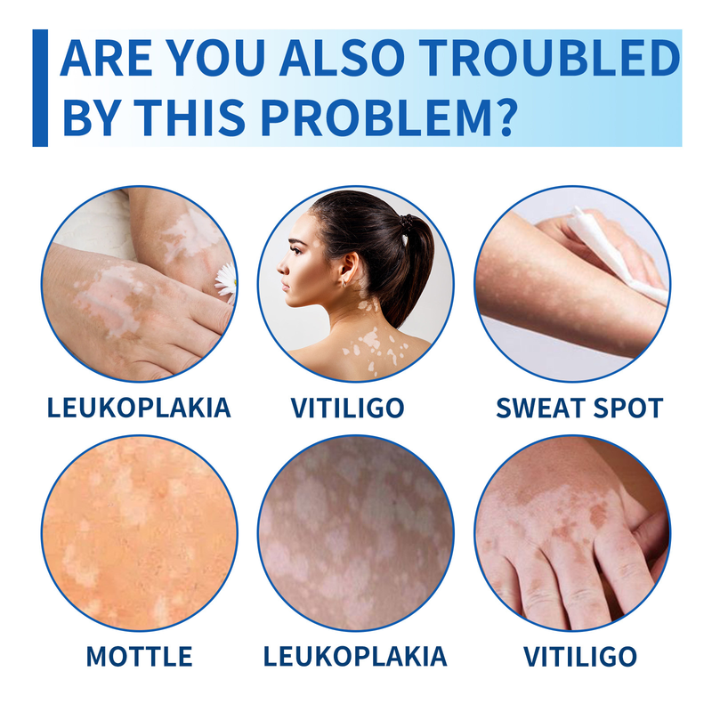 Reparatie Mooie Whitespot Cream voor het verlichten van witte vlekken, bloemvlekken, zweetvlekken Huidreparatie, verenigende huidskleur,_voghion.com