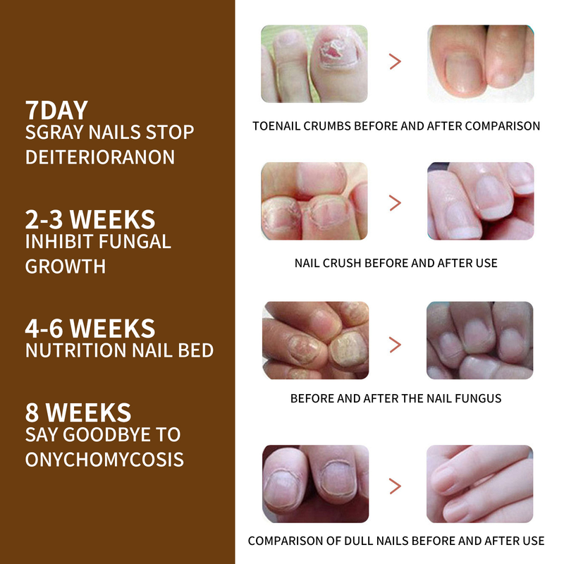 Nail Care Beautiful essence Liquid Repairing Hand, Foot, Nail, Toe, Grey Nail, Shining Nail Moisturizing Liquid , ,_voghion.com