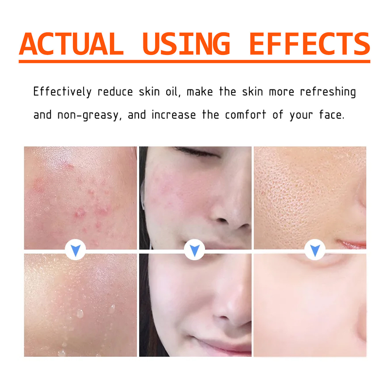 L'acido salicilico di West&Month maschera delicata, pulisce, schiarisce i segni dell'acne, rassoda i pori e pulisce il viso_voghion.com