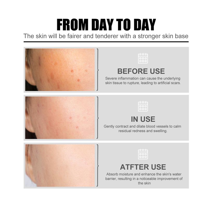 EELHOE Nicotinic Acid Face Essence Lighten Acne Marks, Moisturize Pores, Shrink And Whiten Skin Beauty Essence_voghion.com