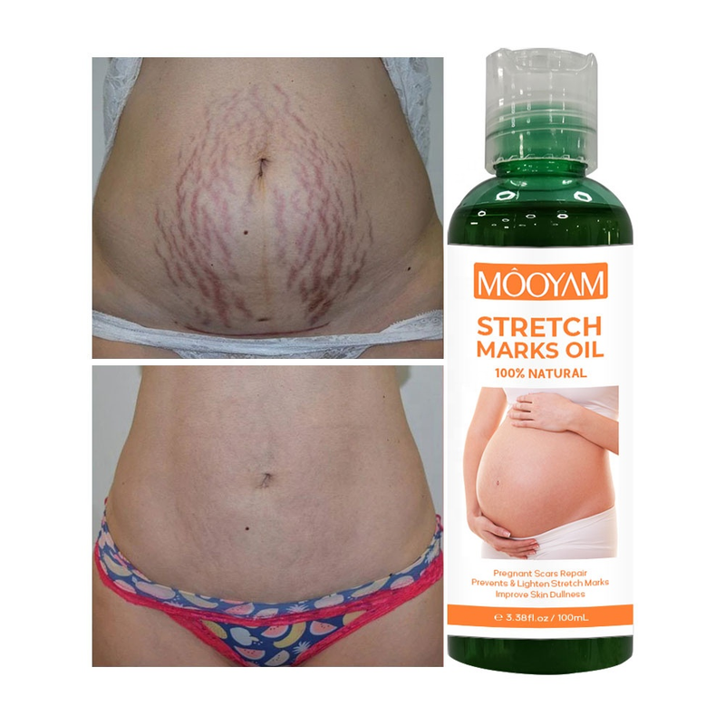 Striae Verwijdering Olie Zwangere Vrouwen Zwangerschap Moederschap Lichaam Nieuwe Oude Striae Verwijdering Crème Verhogen Elasticiteit van de Huid_voghion.com