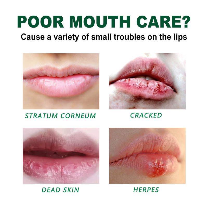 Oral ulcer XIMONTH relief spray_voghion.com