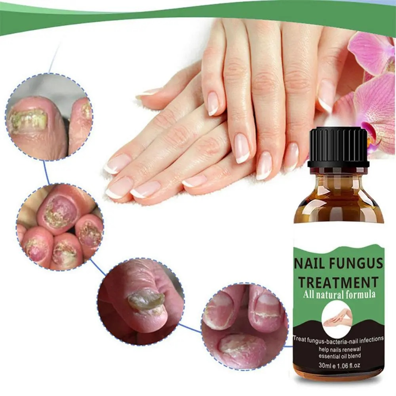 QLZHANFU Nail Repair Solution Toenail Nail Treat Nail Treat Renew Damaged Discolored Foot & Toenails Nails Care Essence Nail Repair Use_voghion.com