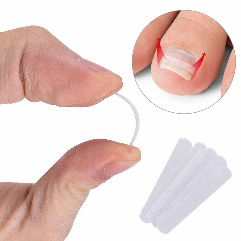10 pièces/ensemble ongle incarné pince à redresser Patch élastique pince à redresser orthèse incurvée ongles Correction élastique autocollant_voghion.com