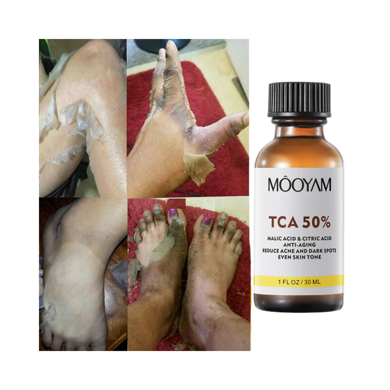 Hoge Kwaliteit TCA 50% Chemische Peel Tca Peel Zure Huid Superforce Peel Pigmentatie Lightening Melanine Acne Behandeling Litteken verwijderen_voghion.com