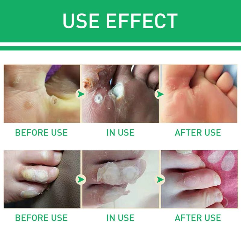 Jaysuing Mild Wart Removing Chicken Eye Smooth Skin and Foot Care Liquid_voghion.com